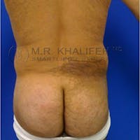 Male Liposuction Gallery - Patient 92865306 - Image 1