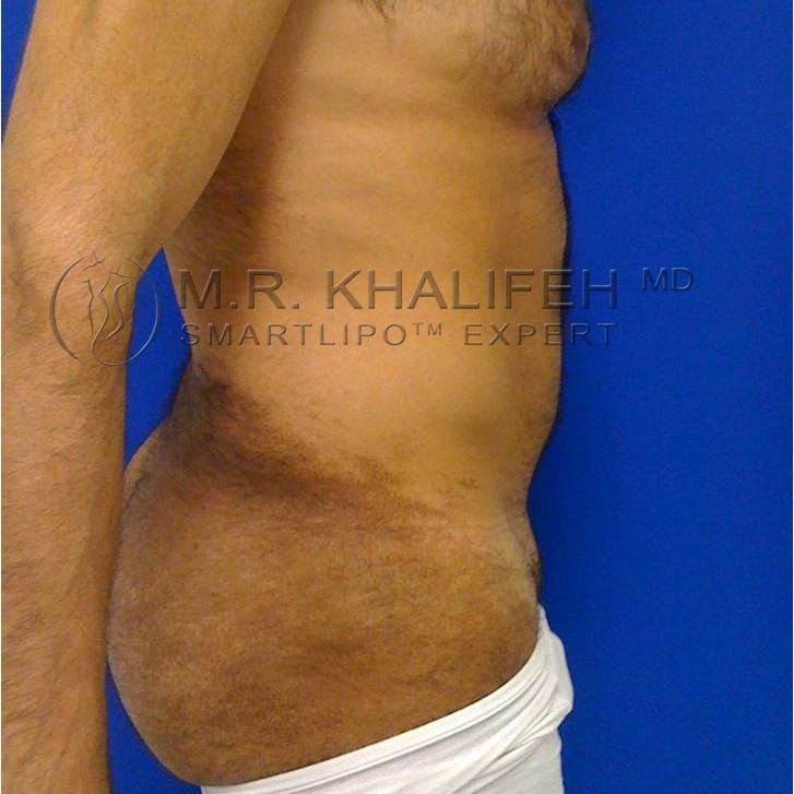 Male Liposuction Gallery - Patient 92865306 - Image 3