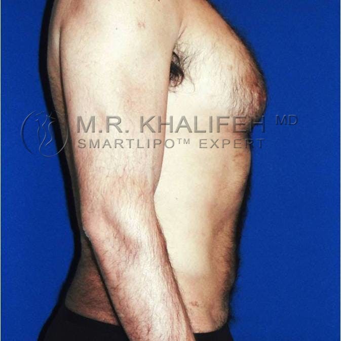 Male Liposuction Gallery - Patient 92865306 - Image 4