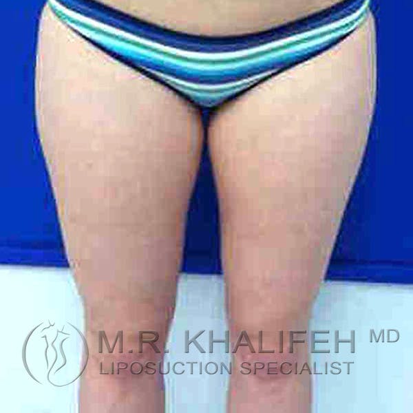 Inner Thigh Liposuction Gallery - Patient 3761693 - Image 1