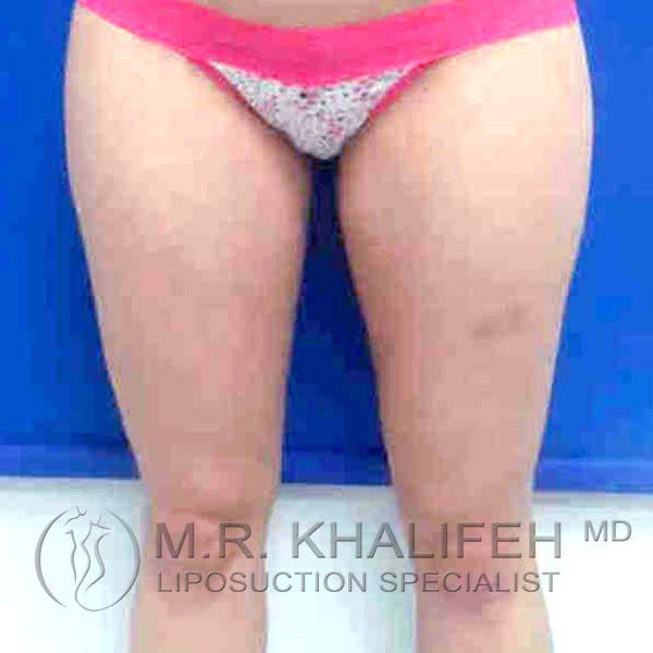 Inner Thigh Liposuction Gallery - Patient 3761693 - Image 2