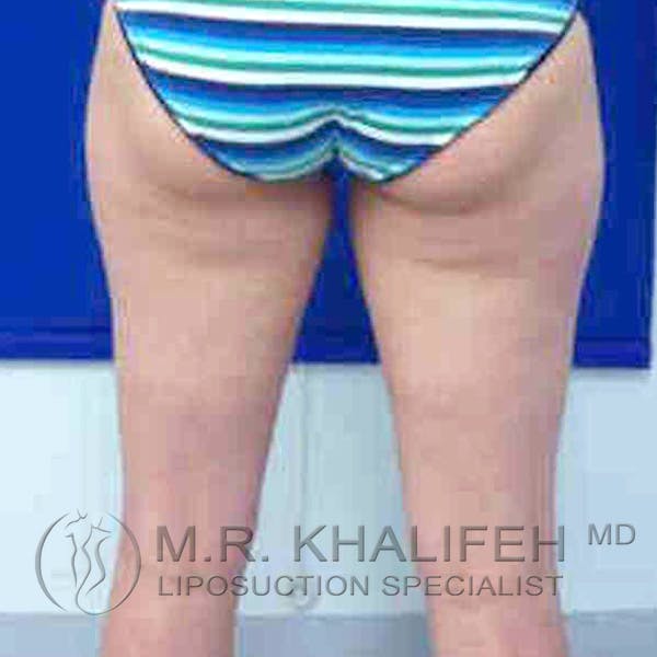Inner Thigh Liposuction Gallery - Patient 3761693 - Image 3