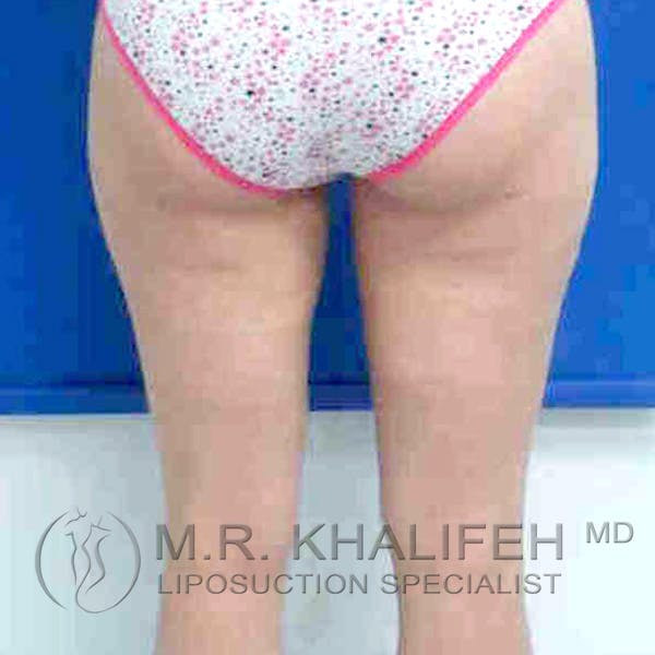 Inner Thigh Liposuction Gallery - Patient 3761693 - Image 4