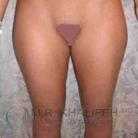 Inner Thigh Liposuction Gallery - Patient 3761700 - Image 1