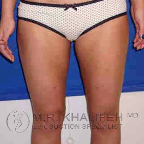 Inner Thigh Liposuction Gallery - Patient 3761700 - Image 2
