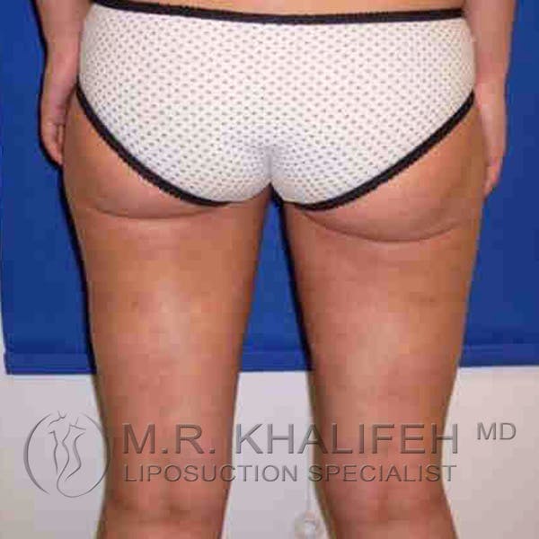 Inner Thigh Liposuction Gallery - Patient 3761700 - Image 4