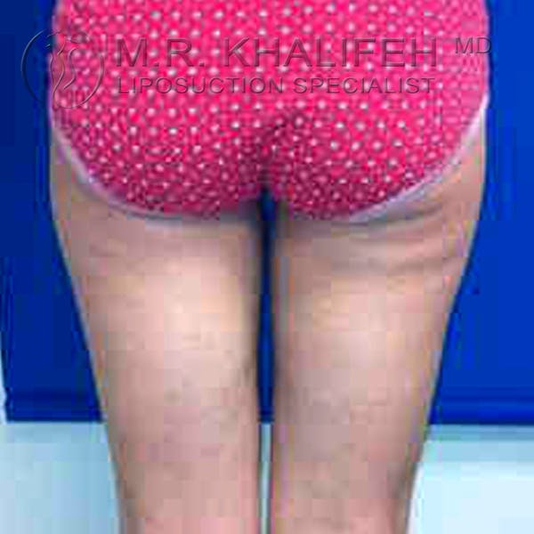 Inner Thigh Liposuction Gallery - Patient 3761715 - Image 4