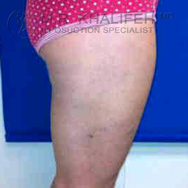 Inner Thigh Liposuction Gallery - Patient 3761715 - Image 6