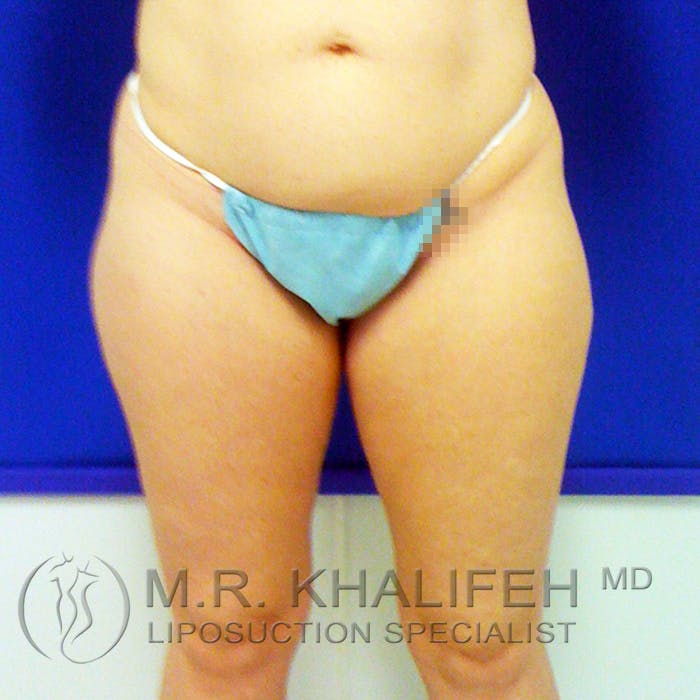 Outer Thigh Liposuction Gallery - Patient 3761723 - Image 1