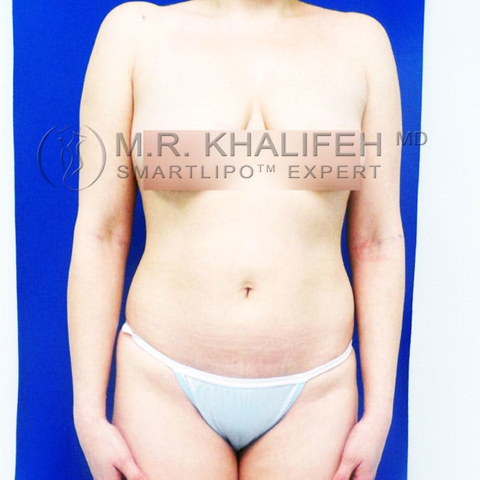 Flank-Lower Back Liposuction Gallery - Patient 92882075 - Image 3