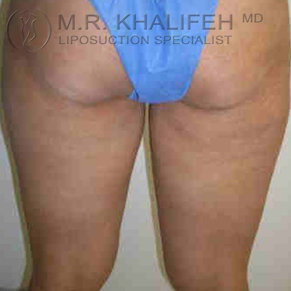 Inner Thigh Liposuction Gallery - Patient 3761719 - Image 1