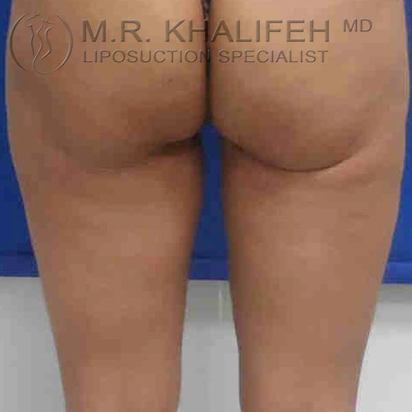 Inner Thigh Liposuction Gallery - Patient 3761719 - Image 2