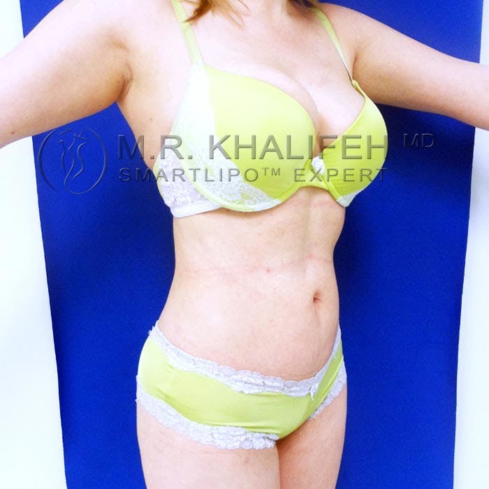 Flank-Lower Back Liposuction Gallery - Patient 92882075 - Image 6