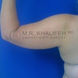 Arm Liposuction Gallery - Patient 3761721 - Image 1