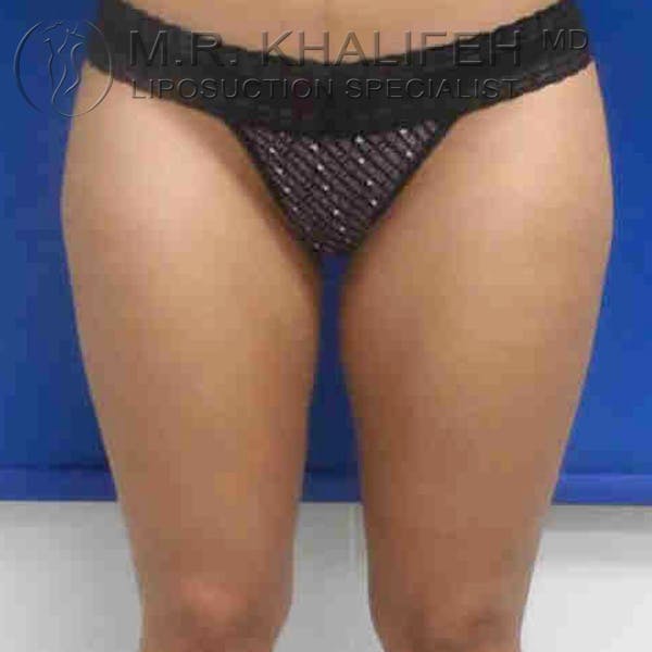 Inner Thigh Liposuction Gallery - Patient 3761719 - Image 4