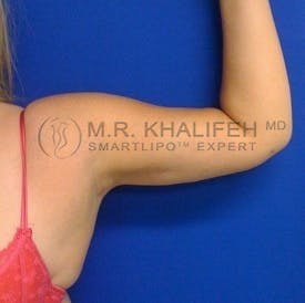 Arm Liposuction Gallery - Patient 3761721 - Image 4