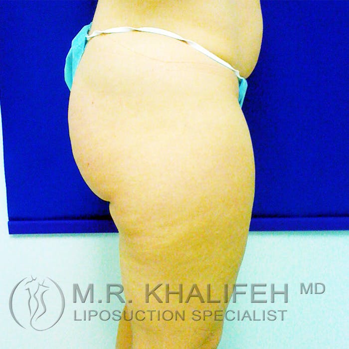 Outer Thigh Liposuction Gallery - Patient 3761723 - Image 7
