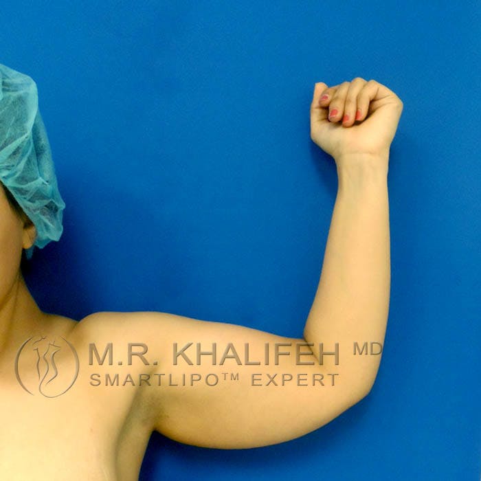 Arm Liposuction Gallery - Patient 3761726 - Image 1