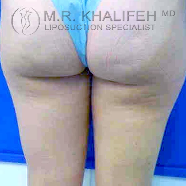 Inner Thigh Liposuction Gallery - Patient 3761724 - Image 3