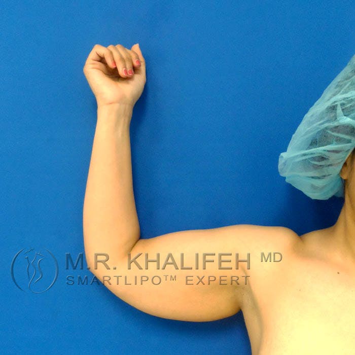 Arm Liposuction Gallery - Patient 3761726 - Image 3
