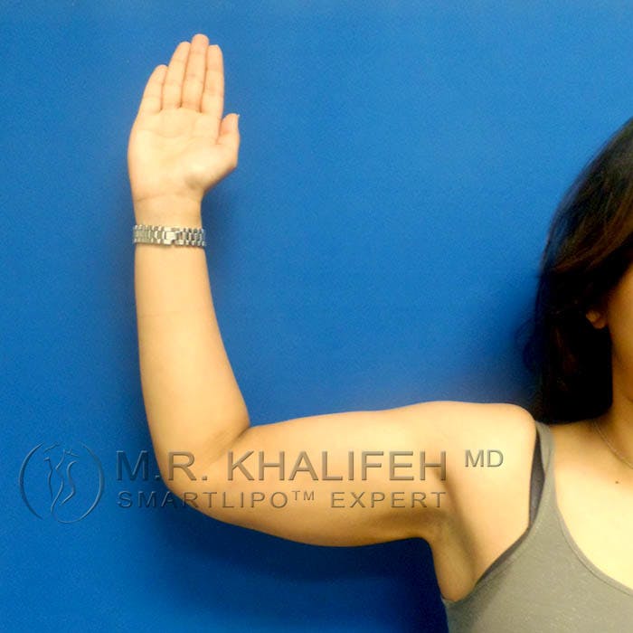 Arm Liposuction Gallery - Patient 3761726 - Image 4