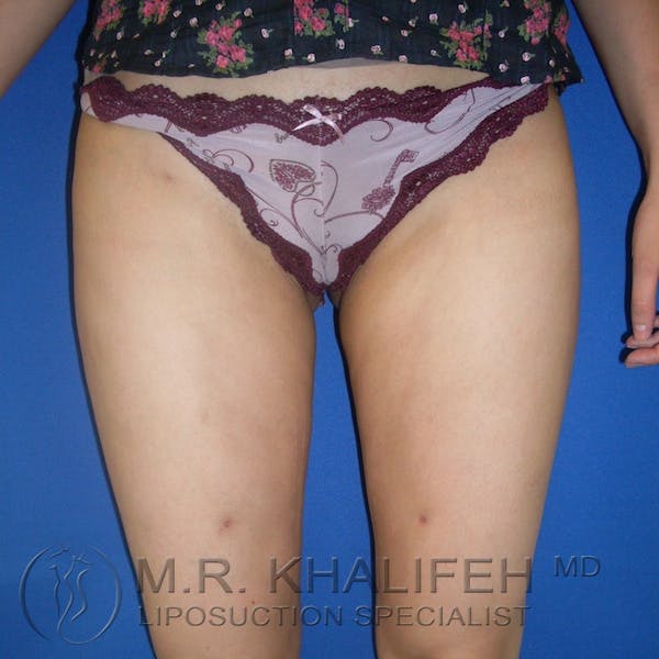 Inner Thigh Liposuction Gallery - Patient 3761727 - Image 2