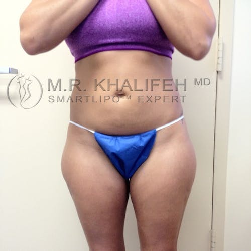 Outer Thigh Liposuction Gallery - Patient 3761730 - Image 5