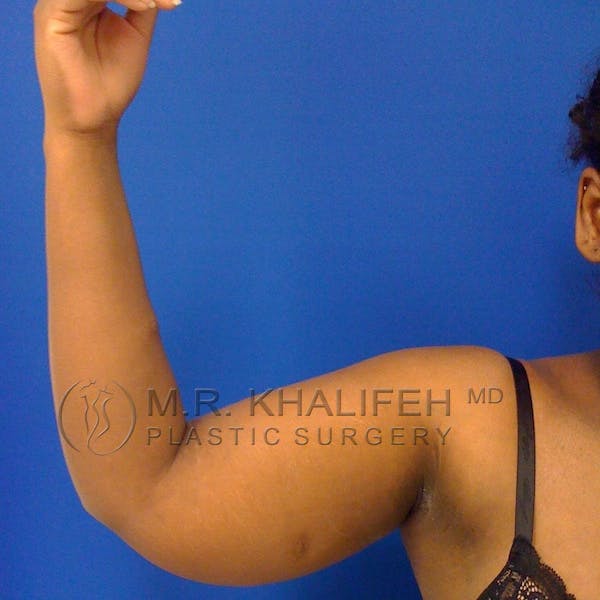 Arm Liposuction Gallery - Patient 3761734 - Image 1