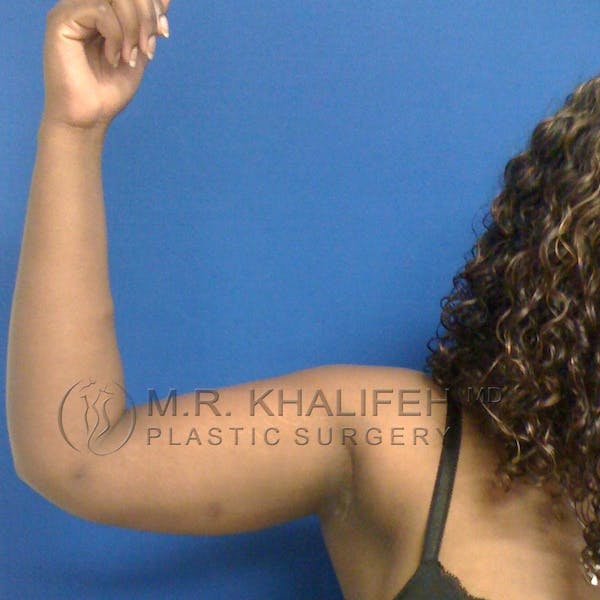 Arm Liposuction Gallery - Patient 3761734 - Image 2