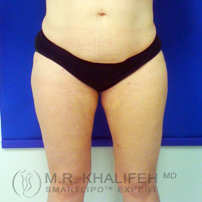 Inner Thigh Liposuction Gallery - Patient 3761735 - Image 2