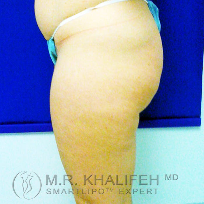 Inner Thigh Liposuction Gallery - Patient 3761735 - Image 3
