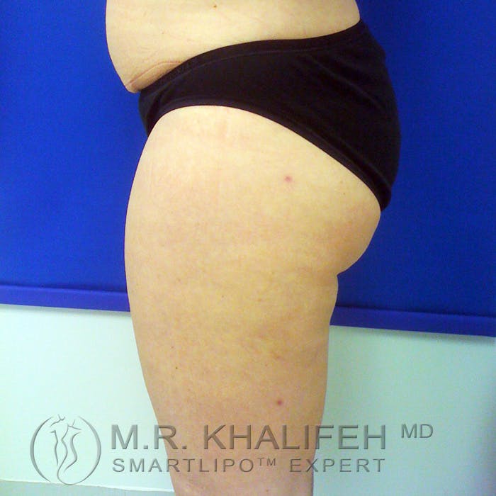 Inner Thigh Liposuction Gallery - Patient 3761735 - Image 4