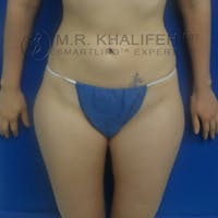 Outer Thigh Liposuction Gallery - Patient 3761739 - Image 1