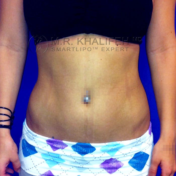 Flank-Lower Back Liposuction Gallery - Patient 92882089 - Image 4