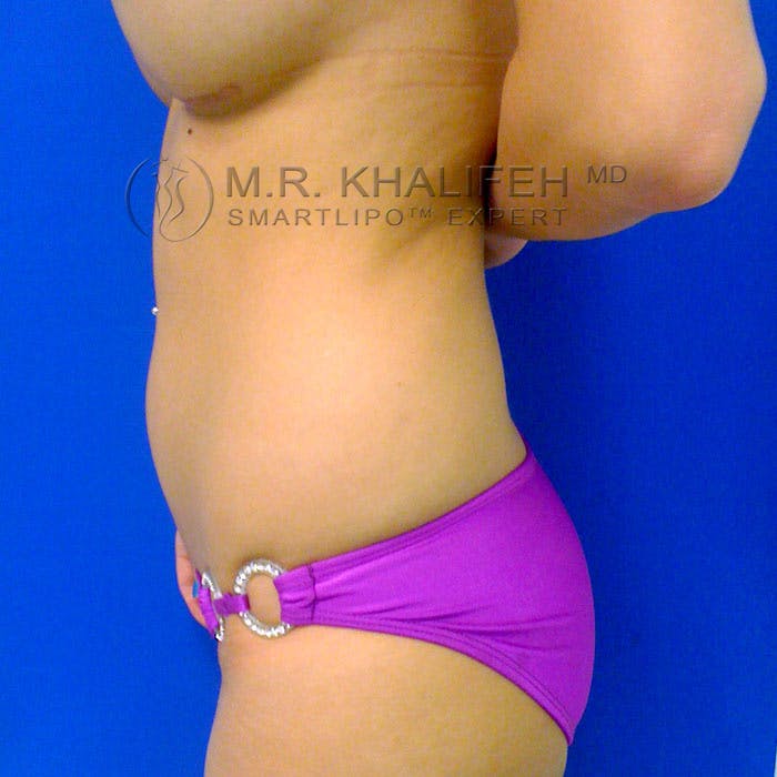 Flank-Lower Back Liposuction Gallery - Patient 92882089 - Image 5