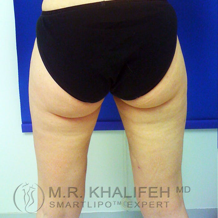 Inner Thigh Liposuction Gallery - Patient 3761735 - Image 6