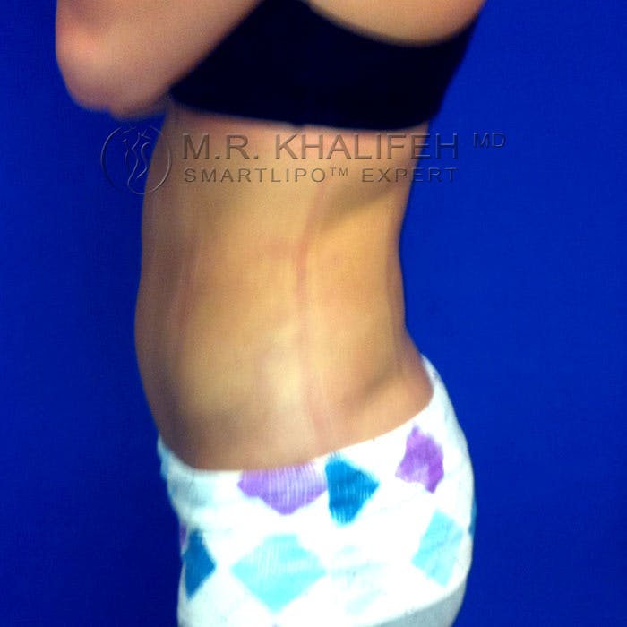 Flank-Lower Back Liposuction Gallery - Patient 92882089 - Image 6