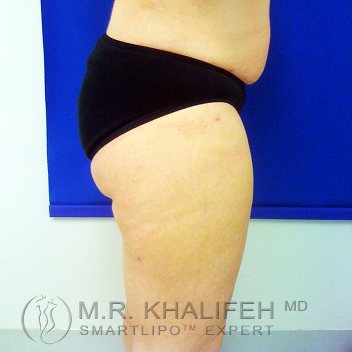 Inner Thigh Liposuction Gallery - Patient 3761735 - Image 8