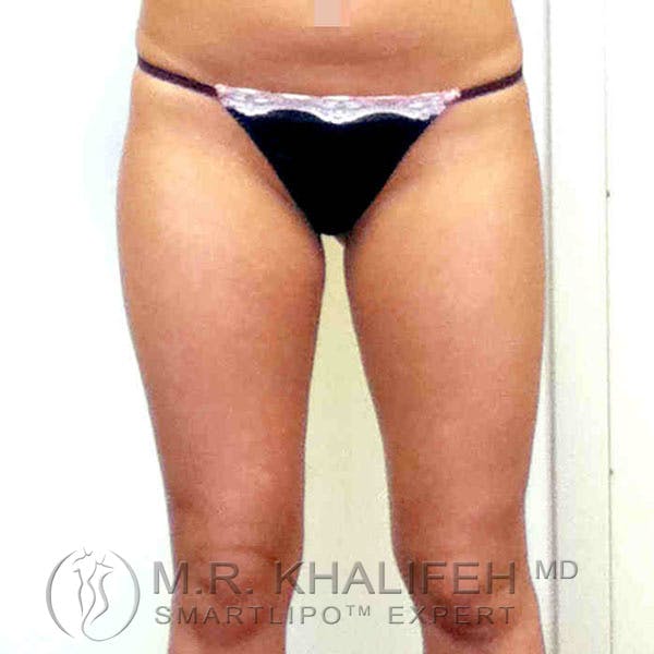 Inner Thigh Liposuction Gallery - Patient 3761742 - Image 1