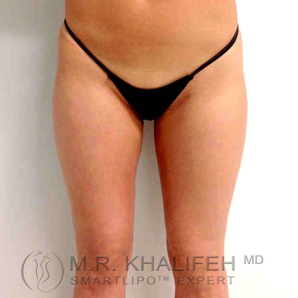 Inner Thigh Liposuction Gallery - Patient 3761742 - Image 2