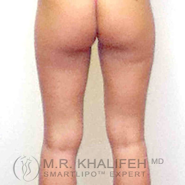 Inner Thigh Liposuction Gallery - Patient 3761742 - Image 5