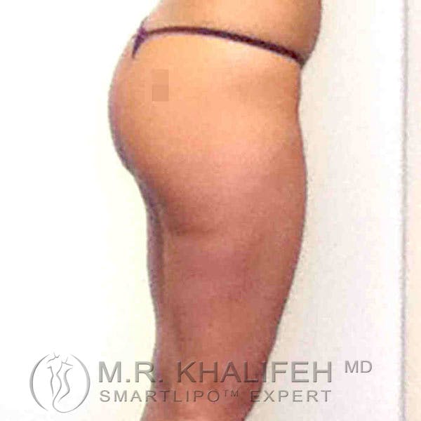 Inner Thigh Liposuction Gallery - Patient 3761742 - Image 7