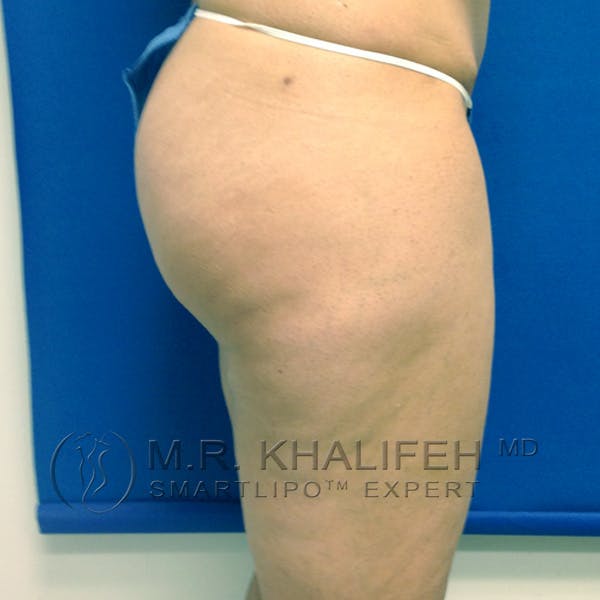 Outer Thigh Liposuction Gallery - Patient 3761750 - Image 5