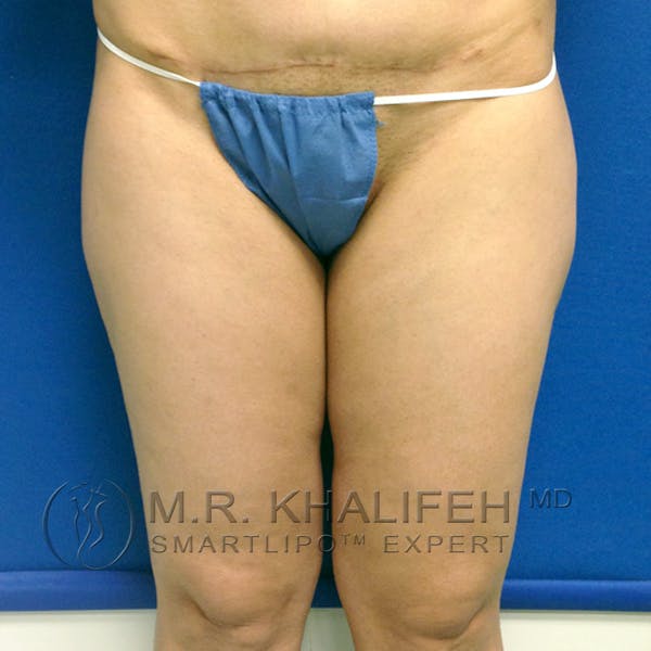 Inner Thigh Liposuction Gallery - Patient 3761755 - Image 1