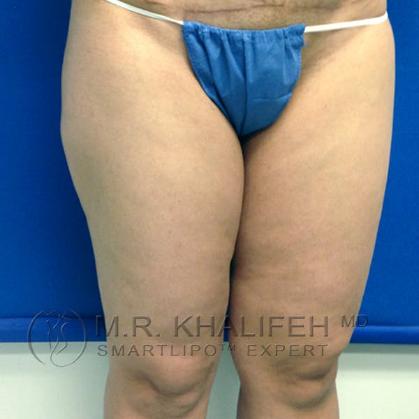 Inner Thigh Liposuction Gallery - Patient 3761755 - Image 3