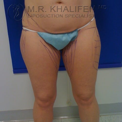 Outer Thigh Liposuction Gallery - Patient 3761760 - Image 1