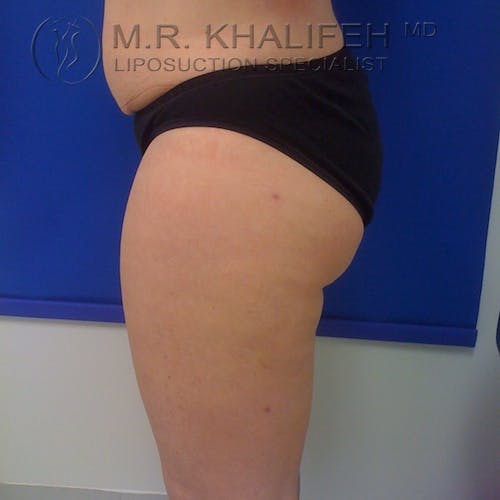 Outer Thigh Liposuction Gallery - Patient 3761760 - Image 4