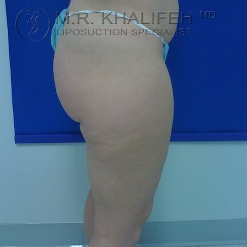 Outer Thigh Liposuction Gallery - Patient 3761760 - Image 7