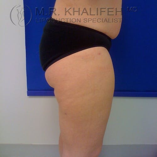 Outer Thigh Liposuction Gallery - Patient 3761760 - Image 8