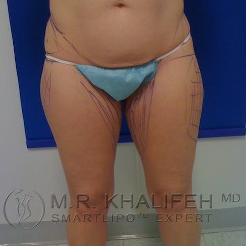 Inner Thigh Liposuction Gallery - Patient 3761769 - Image 1